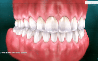 Understanding Tooth Wear Spears Education Video